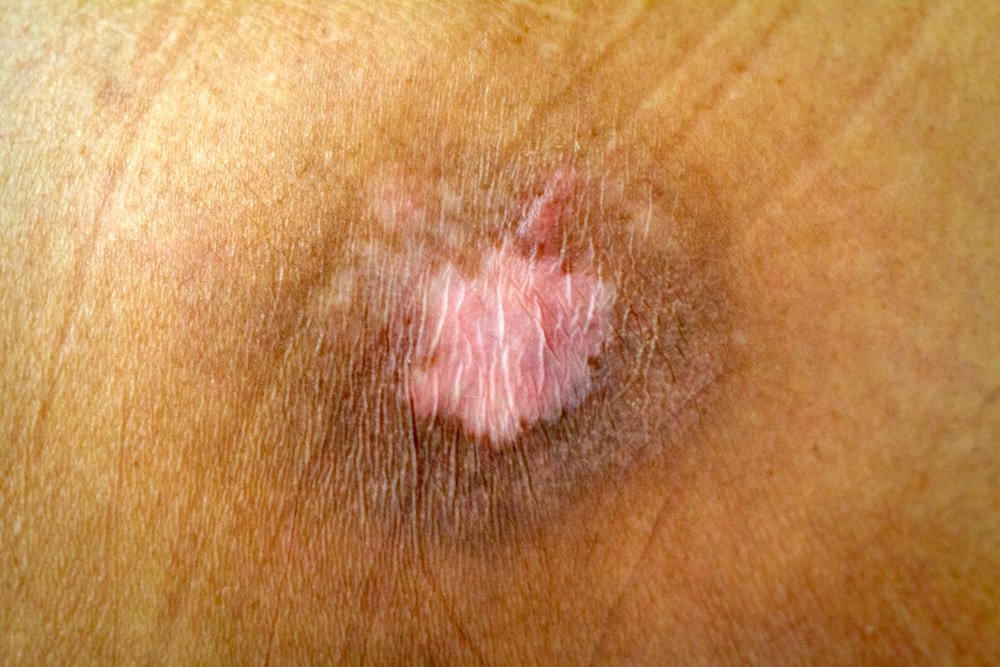 terrible wounds pressure sore